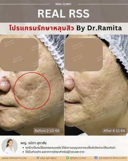 รักษาหลุมสิวราคา? ราคาสามารถบอกอะไรเราได้บ้าง?