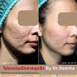 "JUVGEN" นวตกรรมรักษาหลุมสิวโดย ดร.จิน พร้อมให้บริการที่ไทยแล้ววันนี้ ที่ RealClinic 