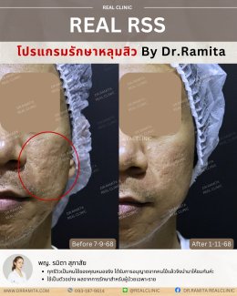 รักษาหลุมสิวราคา? ราคาสามารถบอกอะไรเราได้บ้าง?