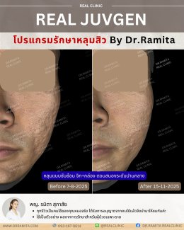 รักษาหลุมสิวราคา? ราคาสามารถบอกอะไรเราได้บ้าง?