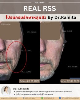 รีวิวหลุมสิว,รักษาหลุมสิว,หลุมสิว,ฟื้นฟูหลุมสิว,juvgen,realclinic