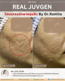 รักษาหลุมสิวราคา? ราคาสามารถบอกอะไรเราได้บ้าง?