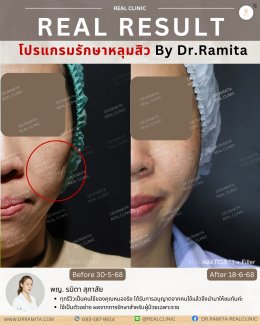 รักษาหลุมสิวราคา? ราคาสามารถบอกอะไรเราได้บ้าง?