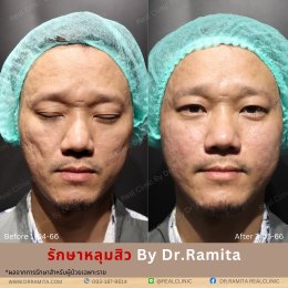 "รักษาหลุมสิว" ที่ Real Clinic By Dr. Ramita พิเศษอย่างไร 