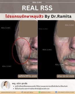 รีวิวหลุมสิว,รักษาหลุมสิว,หลุมสิว,ฟื้นฟูหลุมสิว,juvgen,realclinic