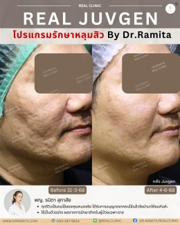 รักษาหลุมสิวราคา? ราคาสามารถบอกอะไรเราได้บ้าง?