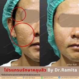 "JUVGEN" นวตกรรมรักษาหลุมสิวโดย ดร.จิน พร้อมให้บริการที่ไทยแล้ววันนี้ ที่ RealClinic 