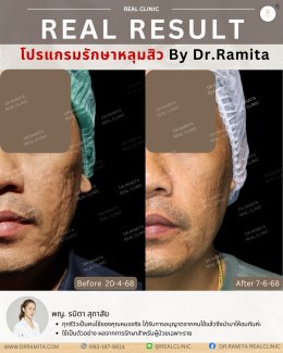 รักษาหลุมสิวราคา? ราคาสามารถบอกอะไรเราได้บ้าง?