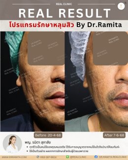 รักษาหลุมสิวราคา? ราคาสามารถบอกอะไรเราได้บ้าง?