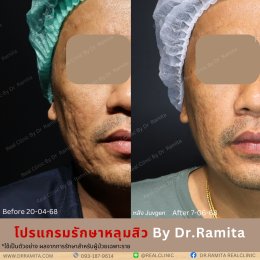 รักษาหลุมสิว,ตัดพังผืด,รักษาหลุมสิว, วิธีรักษาหลุมสิว, Subcision, เติมฟิลเลอร์, Real Scar Synergy, รักษาหลุมสิวที่ไหนดี,Juvgen,acnescarsurgery,acnescarrevision,รักษาหลุมสิวให้ตื้น,เลเซอร์หลุมสิว, รักษาหลุมสิวที่ดีที่สุด,รักษาหลุมสิวให้หายขาด,หลุมสิว,realc