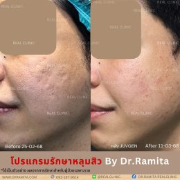 รักษาหลุมสิว,ตัดพังผืด, Subcision  Real Scar Synergy, รักษาหลุมสิวที่ไหนดี,Juvgen,acnescarsurgery,acnescarrevision,รักษาหลุมสิวให้ตื้น,เลเซอร์หลุมสิว, รักษาหลุมสิวที่ดีที่สุด,รักษาหลุมสิวให้หายขาด,หลุมสิว,realclinic , drramita