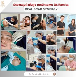juvgen หลุมสิวเกาหลี ดร.จิน รักษาหลุมสิว ศัลยกรรมหลุมสิว ฟื้นฟูหลุมสิว