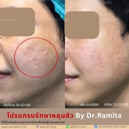 "ฟิลเลอร์หลุมสิว" คืออะไร "ฉีดหลุมสิวฟิลเลอร์" ตัวไหนดี? คุ้มค่าไหมที่จะฉีดฟิลเลอร์หลุมสิว!? 