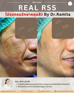 รักษาหลุมสิวราคา? ราคาสามารถบอกอะไรเราได้บ้าง?