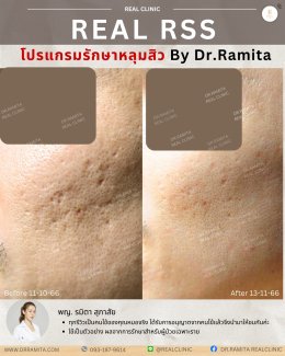 รักษาหลุมสิวราคา? ราคาสามารถบอกอะไรเราได้บ้าง?