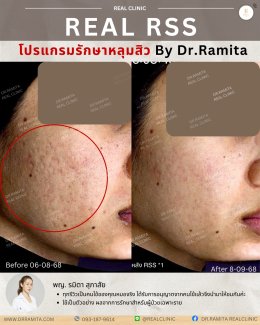 รักษาหลุมสิวราคา? ราคาสามารถบอกอะไรเราได้บ้าง?