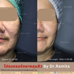 รักษาหลุมสิว,ตัดพังผืด,รักษาหลุมสิว, วิธีรักษาหลุมสิว, Subcision, เติมฟิลเลอร์, Real Scar Synergy, รักษาหลุมสิวที่ไหนดี,Juvgen,acnescarsurgery,acnescarrevision,รักษาหลุมสิวให้ตื้น,เลเซอร์หลุมสิว, รักษาหลุมสิวที่ดีที่สุด,รักษาหลุมสิวให้หายขาด,หลุมสิว,realc