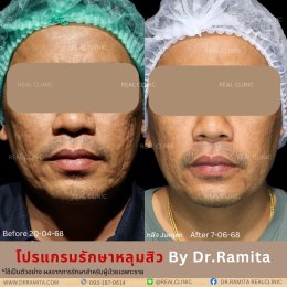 ทำ JUVGEN กับคุณหมอ รมิตา พิเศษอย่างไร?  ถ่ายทอดโดยตรงจาก ดร.จิน 