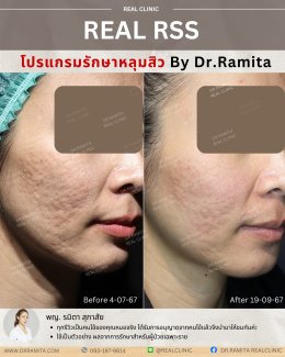 รีวิวหลุมสิว,รักษาหลุมสิว,หลุมสิว,ฟื้นฟูหลุมสิว,juvgen,realclinic