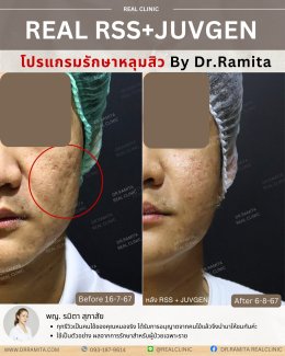 รีวิวหลุมสิว,รักษาหลุมสิว,หลุมสิว,ฟื้นฟูหลุมสิว,juvgen,realclinic