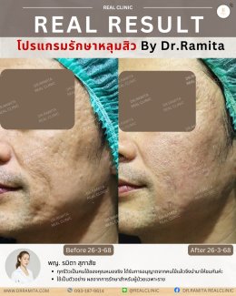 รักษาหลุมสิวราคา? ราคาสามารถบอกอะไรเราได้บ้าง?