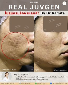 รักษาหลุมสิวราคา? ราคาสามารถบอกอะไรเราได้บ้าง?