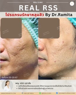 รักษาหลุมสิวราคา? ราคาสามารถบอกอะไรเราได้บ้าง?