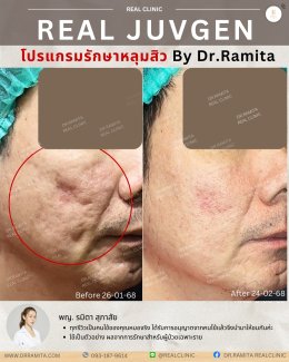 รักษาหลุมสิวราคา? ราคาสามารถบอกอะไรเราได้บ้าง?