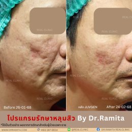 "ฟิลเลอร์หลุมสิว" คืออะไร "ฉีดหลุมสิวฟิลเลอร์" ตัวไหนดี? คุ้มค่าไหมที่จะฉีดฟิลเลอร์หลุมสิว!? 