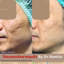 "ฟิลเลอร์หลุมสิว" คืออะไร "ฉีดหลุมสิวฟิลเลอร์" ตัวไหนดี? คุ้มค่าไหมที่จะฉีดฟิลเลอร์หลุมสิว!? 