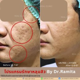 รักษาหลุมสิว,ตัดพังผืด,รักษาหลุมสิว, วิธีรักษาหลุมสิว, Subcision, เติมฟิลเลอร์, Real Scar Synergy, รักษาหลุมสิวที่ไหนดี,Juvgen,acnescarsurgery,acnescarrevision,รักษาหลุมสิวให้ตื้น,เลเซอร์หลุมสิว, รักษาหลุมสิวที่ดีที่สุด,รักษาหลุมสิวให้หายขาด,หลุมสิว,realc