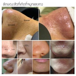 แผลเป็นจากสิวแบบนูน Papular acne scar คืออะไร ?ดูแลได้อย่างไร ?