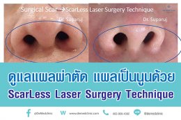 ดูแลแผลผ่าตัด แผลเป็นนูนด้วย ScarLess Laser Surgery Technique