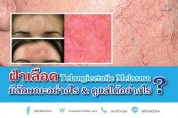 ฝ้าเลือด Telangiectatic Melasma มีลักษณะอย่างไร & ดูแลได้อย่างไร?