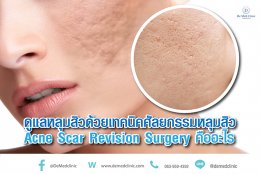 ดูแลหลุมสิวด้วยเทคนิคศัลยกรรมหลุมสิว Acne Scar Revision Surgery คืออะไร