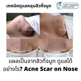 แผลเป็นจากสิวที่จมูก ดูแลได้อย่างไร Acne Scar on Nose ?