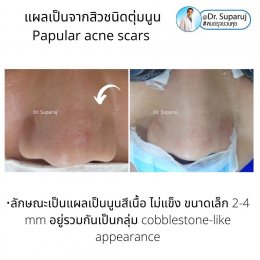 แผลเป็นจากสิวที่จมูก ดูแลได้อย่างไร Acne Scar on Nose ?