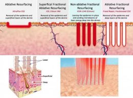 รักษาหลุมสิวด้วยเลเซอร์กรอผิวชนิดลอกทั้งช้ันผิว Full field vs ลอกแบบแบ่งส่วน Fractional Ablative Laser Resurfacing มีจุดเด่นและการใช้แตกต่างกันอย่างไร ?