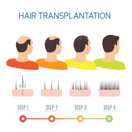 การปลูกผม (Hair Transplantation) คืออะไร