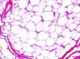 ก้อนเนื้อไขมัน หรือ เนื้องอกไขมัน (Lipoma) คืออะไร ดูแลได้อย่างไร ?