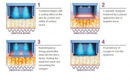 Thermage FLX Body Tip ดูแลปัญหาหน้าท้อง ต้นแขน ต้นขาไม่กระชับอย่างเห็นผล แบบ X 4