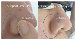 ดูแลแผลผ่าตัด แผลเป็นนูนด้วย ScarLess Laser Surgery Technique