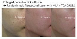 รูขุมขนกว้าง Enlarged Facial Pore เกิดจากอะไรและดูแลได้อย่างไร Part 3/3