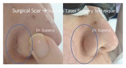 ดูแลแผลเป็นนูนคีลอยด์ ด้วยเทคนิค Fractional Ablative Laser+ทายา*โดยไม่ต้องฉีดยา* :Laser assisted drug delivery