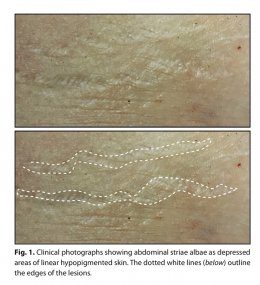 ผิวแตกลาย หรือ รอยแตกลาย (Stretch Mark หรือ Striae) ดูแลได้อย่างไร ?