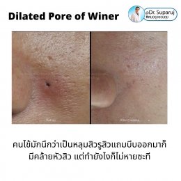 Dilated Pore of Winer เหมือนรูหลุมสิว...แต่ไม่ใช่