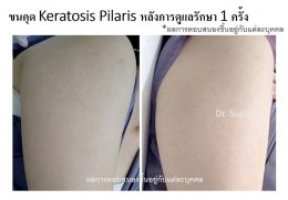 คำแนะนำในการดูแลผิวสำหรับผู้ที่มีปัญหาขนคุด KP Keratosis Pilaris