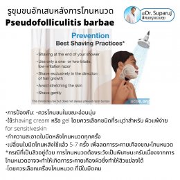 คล้ายสิว…แต่ไม่ใช่สิว: รูขุมขนอักเสบหลังการโกนหนวด Pseudofolliculitis barbae, Razor bump +เทคนิคการโกนหนวดเพื่อลดการเกิดรูขุมขนอักเสบครับ