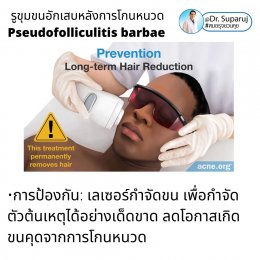 คล้ายสิว…แต่ไม่ใช่สิว: รูขุมขนอักเสบหลังการโกนหนวด Pseudofolliculitis barbae, Razor bump +เทคนิคการโกนหนวดเพื่อลดการเกิดรูขุมขนอักเสบครับ