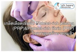 แนะนำเทคนิคดูแลหลุมสิว ep. 12 เกล็ดเลือดเข้มข้น Platelet-rich plasma (PRP)ในการดูแลรักษาหลุมสิว PRP in Acne Scar Treatment (อย่างละเอียดครับ)